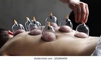 Dry Cupping TherapyCupping Therapy